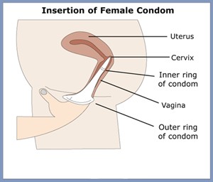 how to use a female condom
