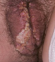 picture of woman with genital warts