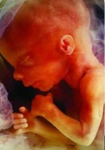 picture of intrauterine fetal death
