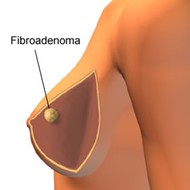 pictures of breast lumps