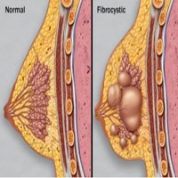 fibrocystic condition