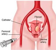 UAE Fibroids Embolization