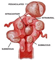 Types of Uterine Fibroids