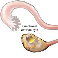 Image of Functional Ovary Cyst