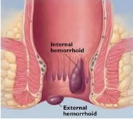 Treating Hemorrhoids In Pregnant Women