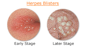 Herpes blisters