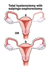 Hysterectomy with Salpingo Oophorectomy