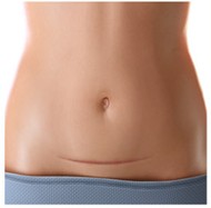 picture of hysterectomy scar