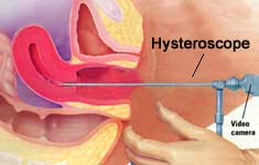 Hysteroscope in doctors office