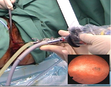 hysteroscopy operation