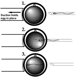 diagram of icsi in progress
