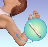 Picture of Implant