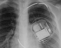xray of ICD device after surgery