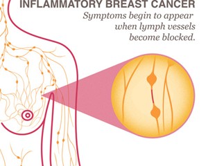 diagram of inflammatory breast cancer