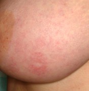 early signs of inflammatory breast cancer