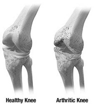 Knee Problems