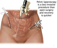 pelvic laparoscopy