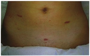 laparoscopy scars