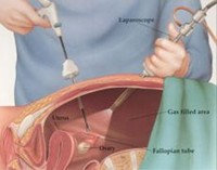 Laparoscopy