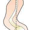 Lordosis
