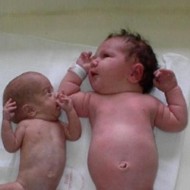 Fetus Growth Restriction