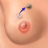 Lumpectomy Picture