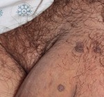 male genital warts