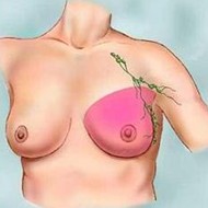 Mastectomiies Diagram