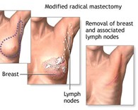 Mastectomy Picture