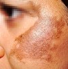melasma pictures