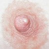milk blister
