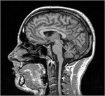 mri brain scan