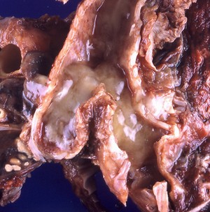 Muscus in lungs from asthma