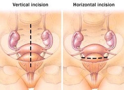 types of myomectomy incisions