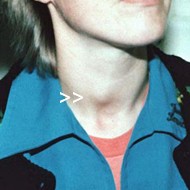 picture of woman with a nodule