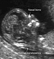 nuchal nose measurement picture