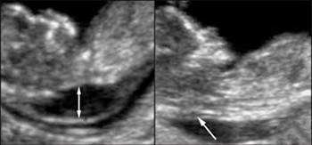 nuchal scan picture