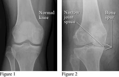 xray of osteoarthritis