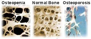 picture of osteopenia