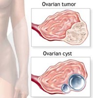 Difference Between Cysts And Tumors