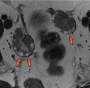 picture of multiple cysts on mri scan