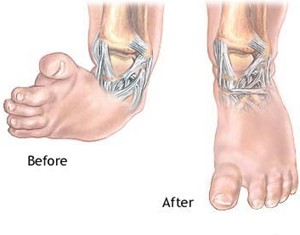 Surgery for Clubfeet