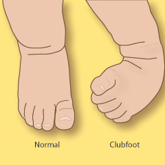 Diagram Clubfoot