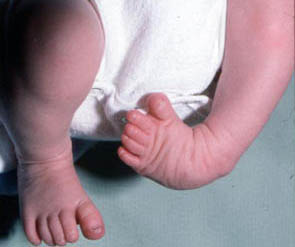 clubfoot baby
