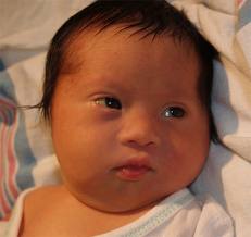 Down Syndrome Baby