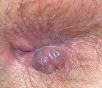 External Hemorrhoids