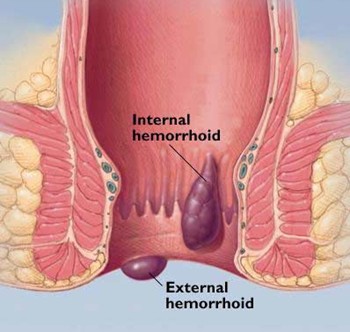 Hemorrhoids