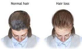 pcos hair loss picture