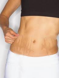 Aged Stretch Marks