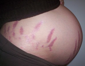 Stretch Marks